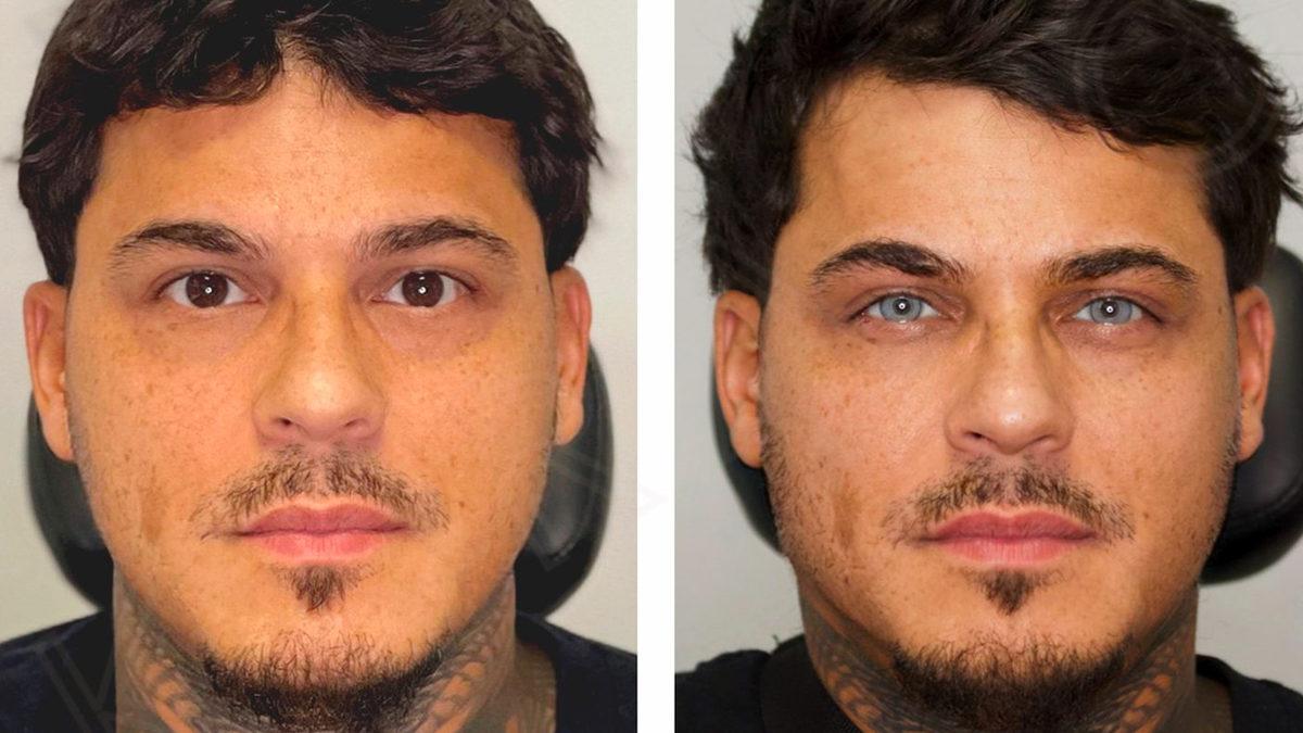 Göz Renginizi Estetik Operasyonla Değiştirmek İstediğinizde Neleri 