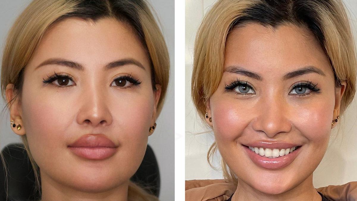 Göz Renginizi Estetik Operasyonla Değiştirmek İstediğinizde Neleri 