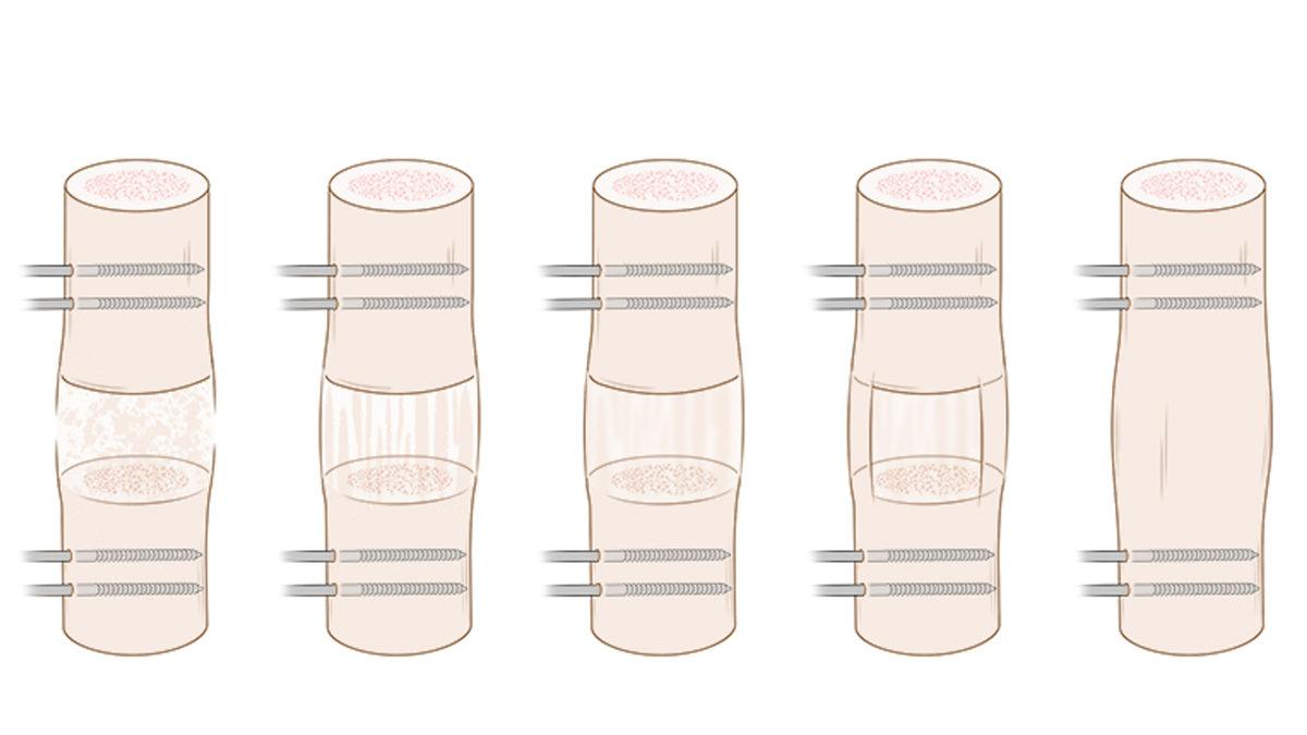 Bilimin Penceresinden: Bugünlerde Sıkça Duyduğumuz Boy Uzatma Ameliyatlarını Tüm Artı ve Eksi Yönleriyle Değerlendirdik