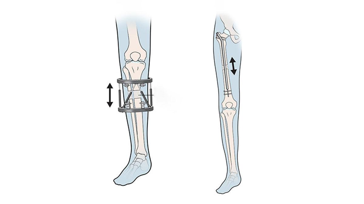 Bilimin Penceresinden: Bugünlerde Sıkça Duyduğumuz Boy Uzatma Ameliyatlarını Tüm Artı ve Eksi Yönleriyle Değerlendirdik