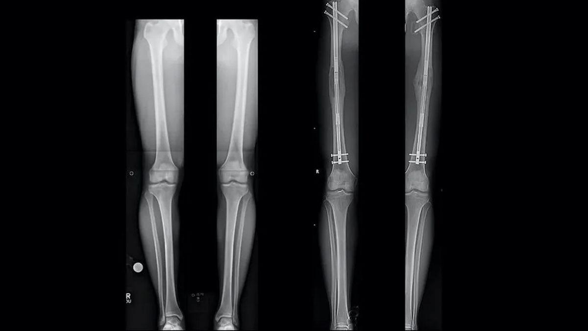 Bilimin Penceresinden: Bugünlerde Sıkça Duyduğumuz Boy Uzatma Ameliyatlarını Tüm Artı ve Eksi Yönleriyle Değerlendirdik