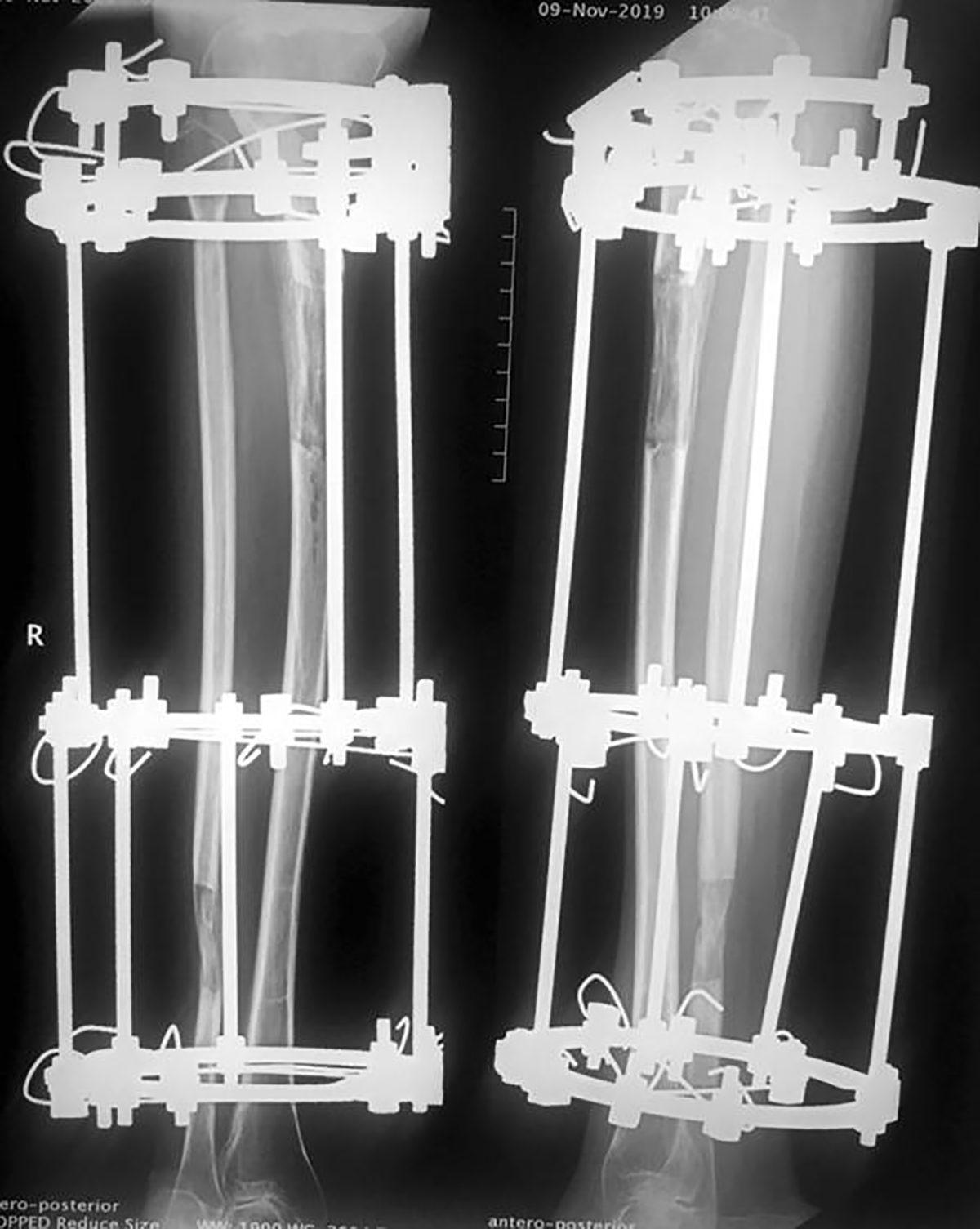 Bilimin Penceresinden: Bugünlerde Sıkça Duyduğumuz Boy Uzatma Ameliyatlarını Tüm Artı ve Eksi Yönleriyle Değerlendirdik