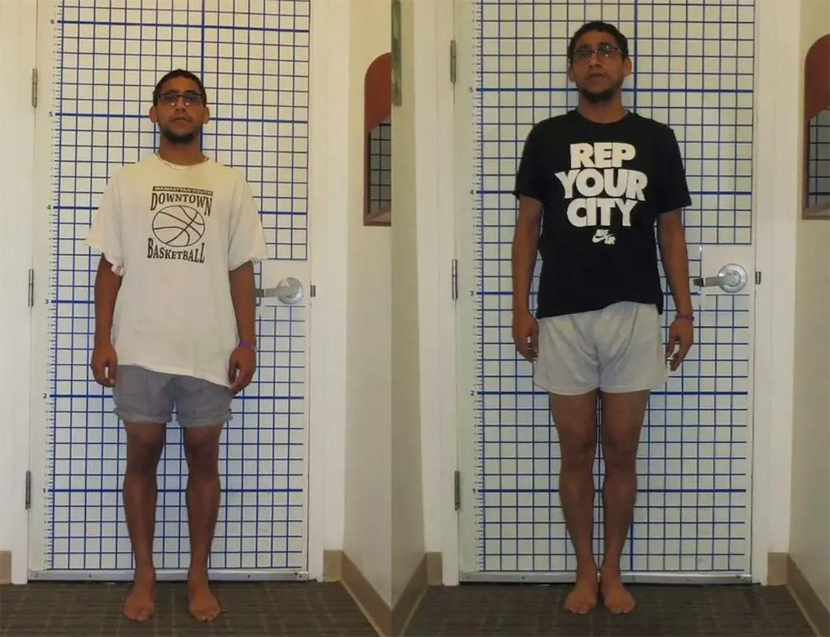 Bilimin Penceresinden: Bugünlerde Sıkça Duyduğumuz Boy Uzatma Ameliyatlarını Tüm Artı ve Eksi Yönleriyle Değerlendirdik