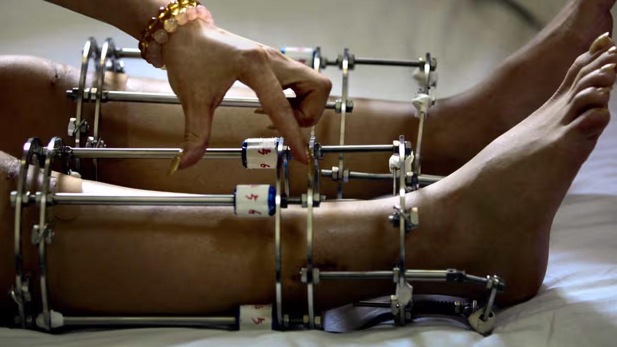 Bilimin Penceresinden: Bugünlerde Sıkça Duyduğumuz Boy Uzatma Ameliyatlarını Tüm Artı ve Eksi Yönleriyle Değerlendirdik