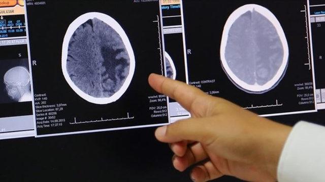 Dünyada İlk Kez, Bir Çocuğun Ölümcül Beyin Kanseri Tedavi Edildi