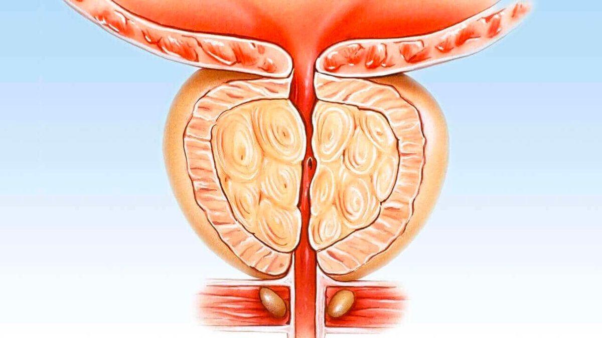 Erkeklerin Prostat Kanserine Bu Kadar Fazla Yakalanmasının Sebebi Nedir? Hele de 40 Yaşını Geçtiyse!