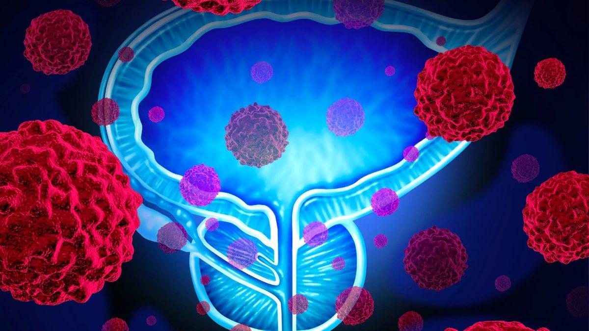Erkeklerin Prostat Kanserine Bu Kadar Fazla Yakalanmasının Sebebi Nedir? Hele de 40 Yaşını Geçtiyse!