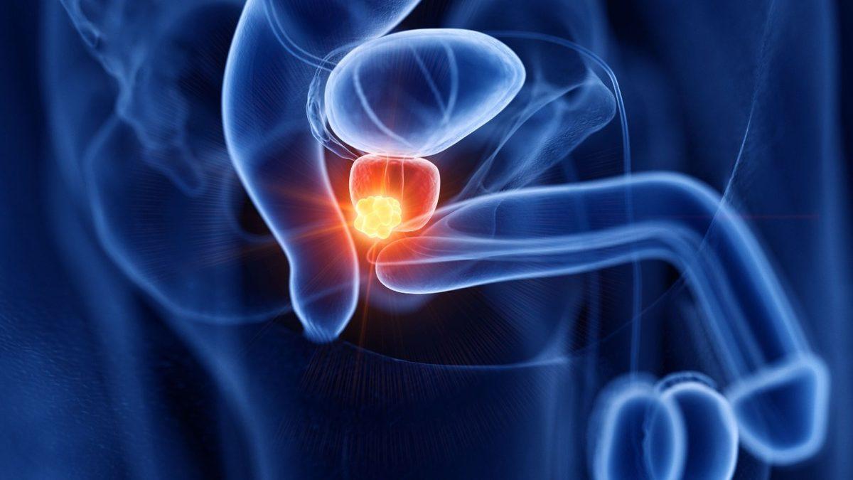 Erkeklerin Prostat Kanserine Bu Kadar Fazla Yakalanmasının Sebebi Nedir? Hele de 40 Yaşını Geçtiyse!