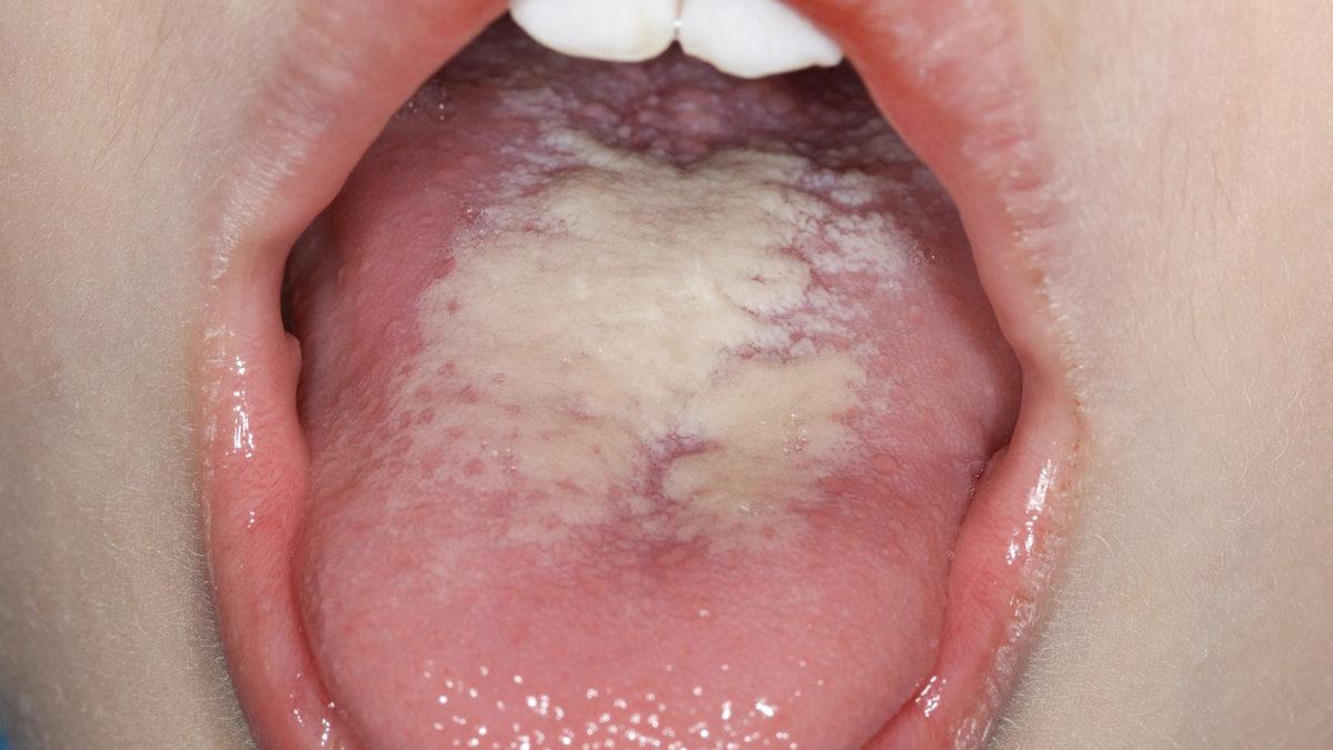 Dilimizde Oluşan Bu Beyazlıkların Altında Yatan Sebep Tam Olarak Ne?