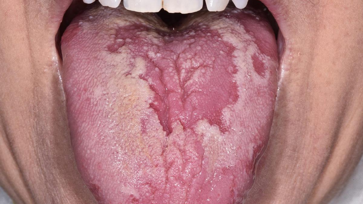 Dilimizde Oluşan Bu Beyazlıkların Altında Yatan Sebep Tam Olarak Ne?