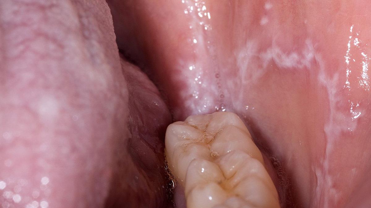 Dilimizde Oluşan Bu Beyazlıkların Altında Yatan Sebep Tam Olarak Ne?