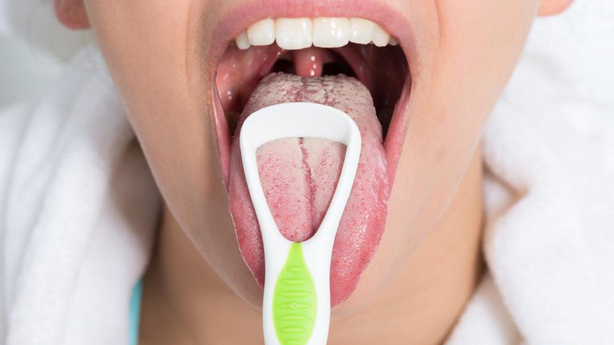 Dilimizde Oluşan Bu Beyazlıkların Altında Yatan Sebep Tam Olarak Ne?