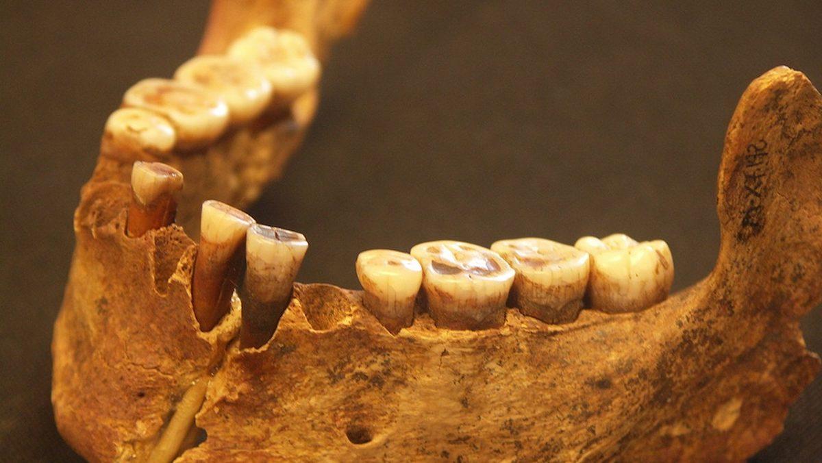 Ne Diş Fırçası Ne de Diş Macunu Kullanan Eski İnsanların Dişleri Neden Hiç Çürümüyordu?