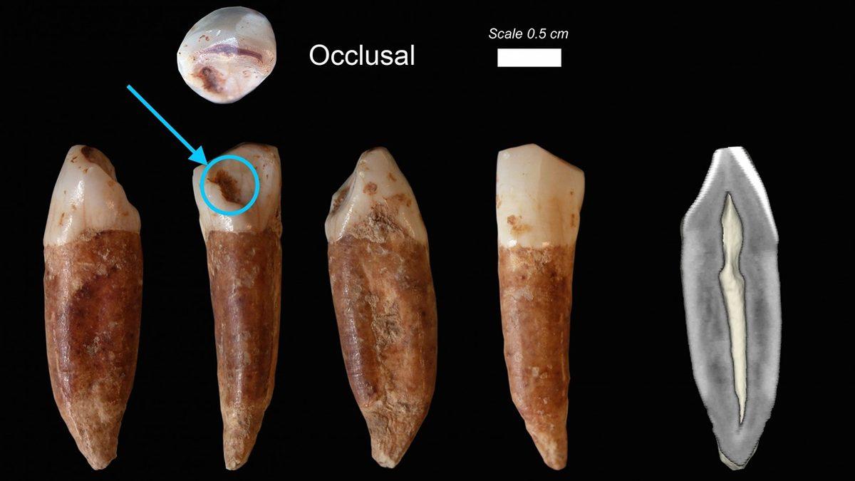 Ne Diş Fırçası Ne de Diş Macunu Kullanan Eski İnsanların Dişleri Neden Hiç Çürümüyordu?