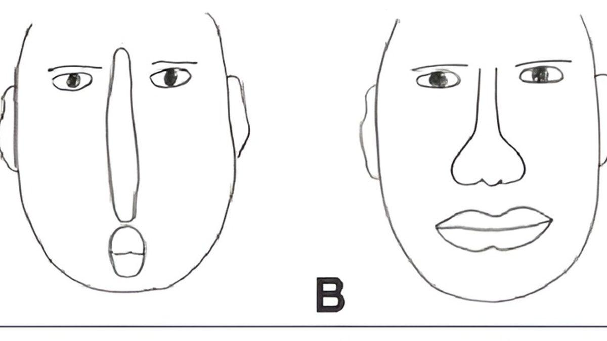 İnsan Yüzlerini Korkutucu Bir Snapchat Filtresi Gibi Görmenize Neden Olan Bozukluk: Prosopometamorfopsi