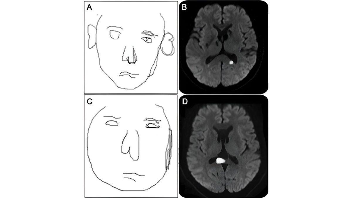İnsan Yüzlerini Korkutucu Bir Snapchat Filtresi Gibi Görmenize Neden Olan Bozukluk: Prosopometamorfopsi