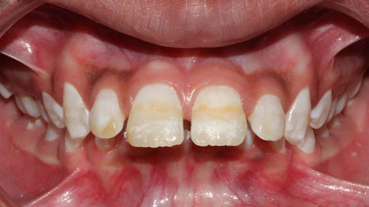 Bazen Tadı Güzel Hissettiren Diş Macununu Çok Fazla Yutarsak Ne Olur?