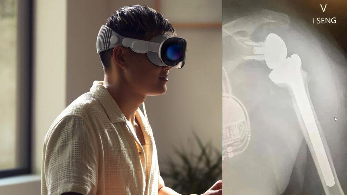 Apple Vision Pro, Yine Ameliyatta Kullanıldı: Omuz İmplantı Başarıyla Takıldı!