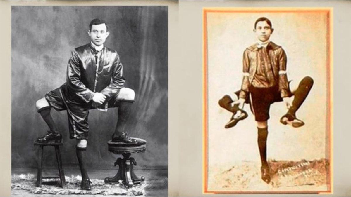 Üç Bacak ve İki Penisle Doğan Frank Lentini’nin Pek Çok Kişiye İlham Olabilecek Hayat Öyküsü