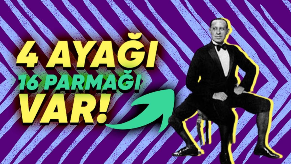 Üç Bacak ve İki Penisle Doğan Frank Lentini’nin Pek Çok Kişiye İlham Olabilecek Hayat Öyküsü