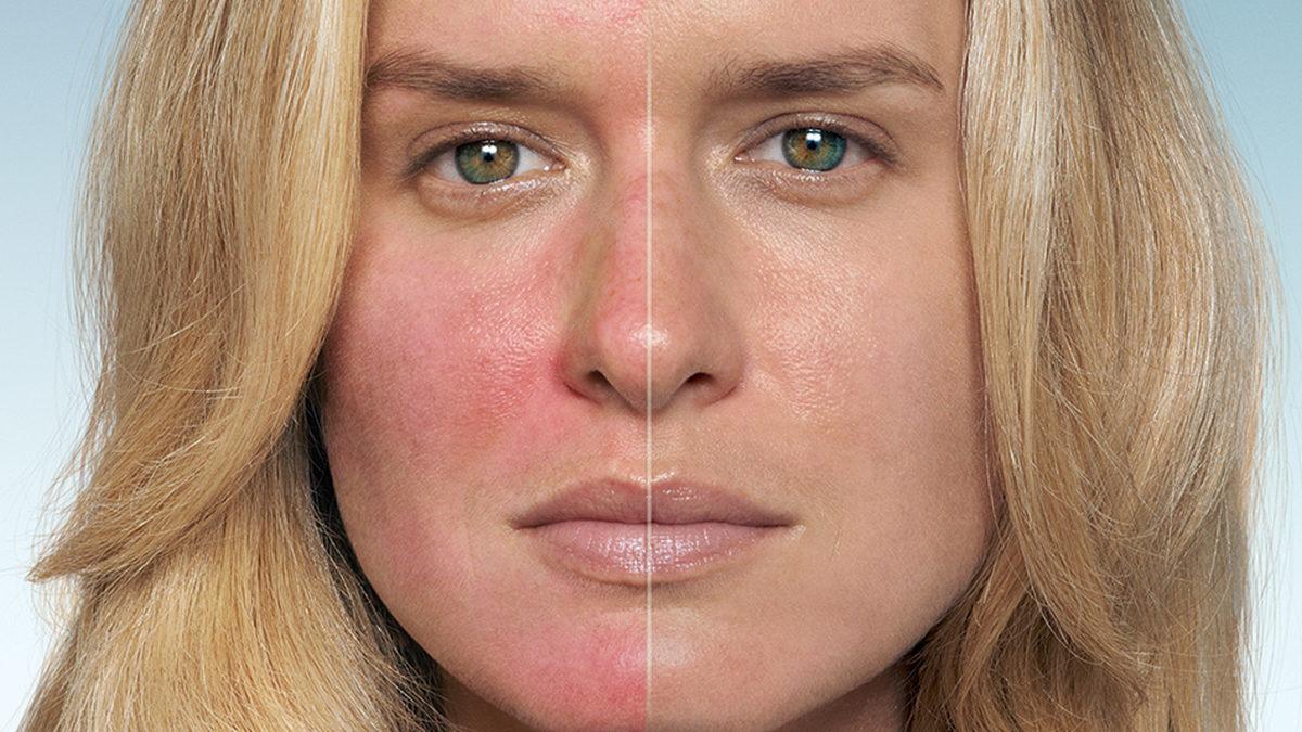 Alkol Aldıktan Sonra Neden Bazı İnsanların Yüzü Domates Gibi Kızarır? Sebebi Ortamlarda Gülüp Geçilecek Kadar Eğlenceli Değil!