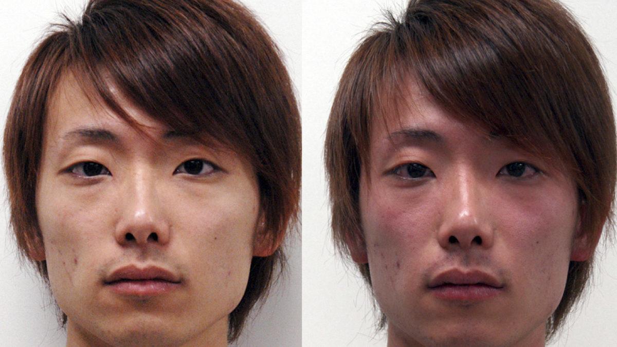 Alkol Aldıktan Sonra Neden Bazı İnsanların Yüzü Domates Gibi Kızarır? Sebebi Ortamlarda Gülüp Geçilecek Kadar Eğlenceli Değil!