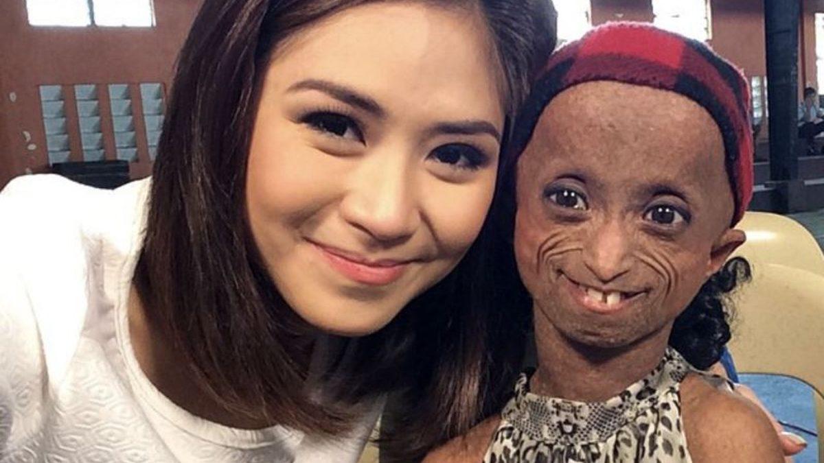 Çocukken Yaşlı Görünmeye Sebep Olan İlginç Sendrom: Progeria (Türkiye’de de Örnekleri Var!)