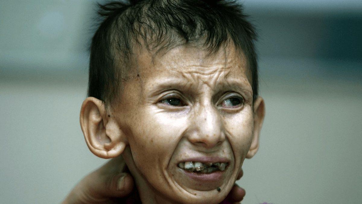 Çocukken Yaşlı Görünmeye Sebep Olan İlginç Sendrom: Progeria (Türkiye’de de Örnekleri Var!)
