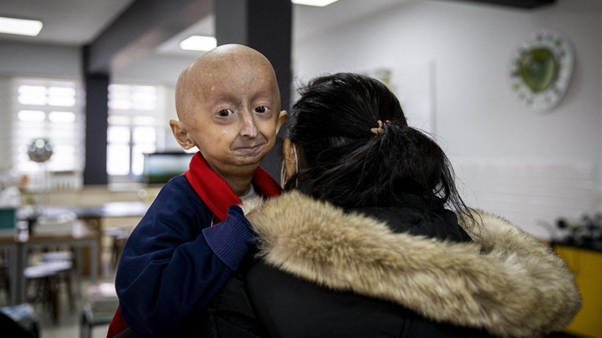 Çocukken Yaşlı Görünmeye Sebep Olan İlginç Sendrom: Progeria (Türkiye’de de Örnekleri Var!)