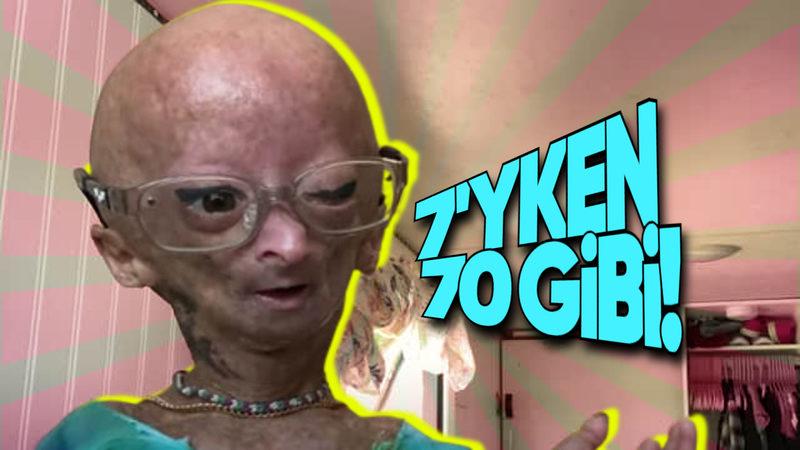 Çocukken Yaşlı Görünmeye Sebep Olan İlginç Sendrom: Progeria (Türkiye’de de Örnekleri Var!)