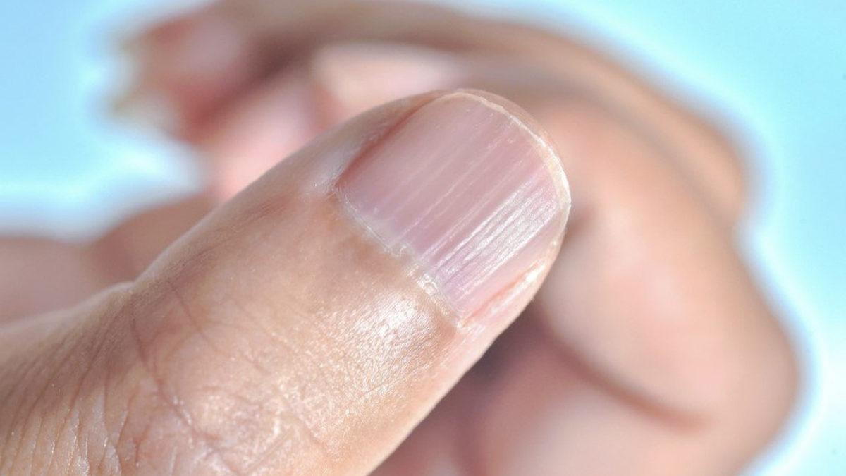 Tırnaktaki Bu Dikine Çıkıntılar Neden Olur? Önlemek İçin Neler Yapabilirsiniz?