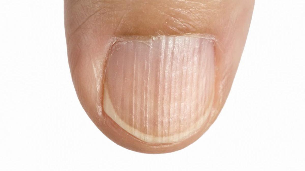 Tırnaktaki Bu Dikine Çıkıntılar Neden Olur? Önlemek İçin Neler Yapabilirsiniz?