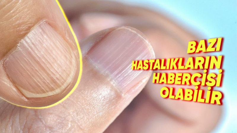 Tırnaktaki Bu Dikine Çıkıntılar Neden Olur? Önlemek İçin Neler Yapabilirsiniz?