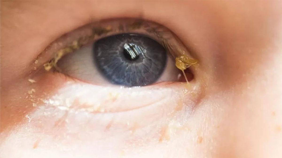 Gece Ne Oluyor da Sabah Uyandığımızda Gözümüzde Çapaklar Oluşuyor?