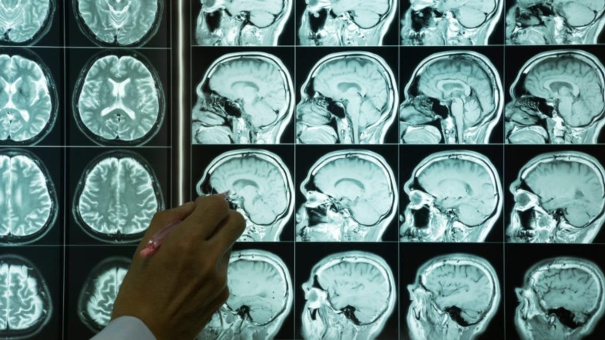 Bilim İnsanları, İklim Değişikliği Yüzünden Beyin Hastalıklarının Ağırlaştığını Açıkladı