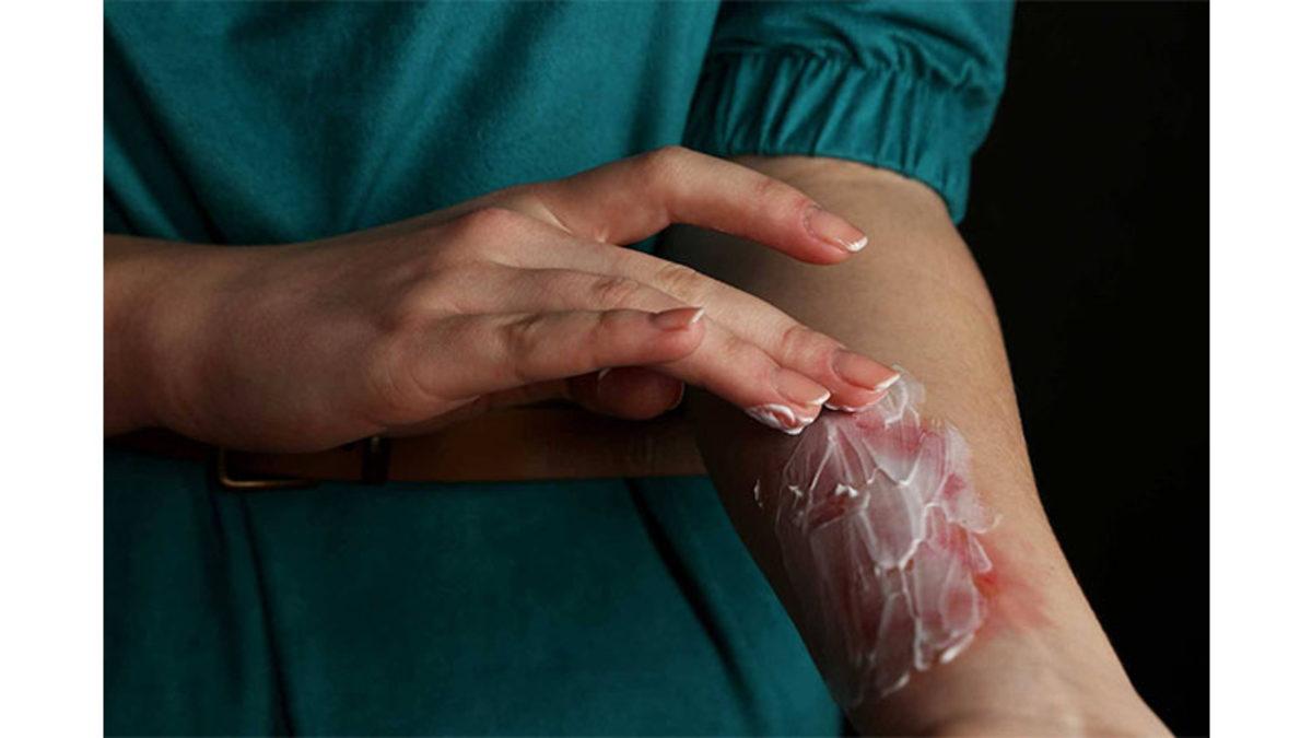 Buz, Soğuk Olmasına Rağmen Dokunduğumuzda Nasıl Elimizi Yakabiliyor?