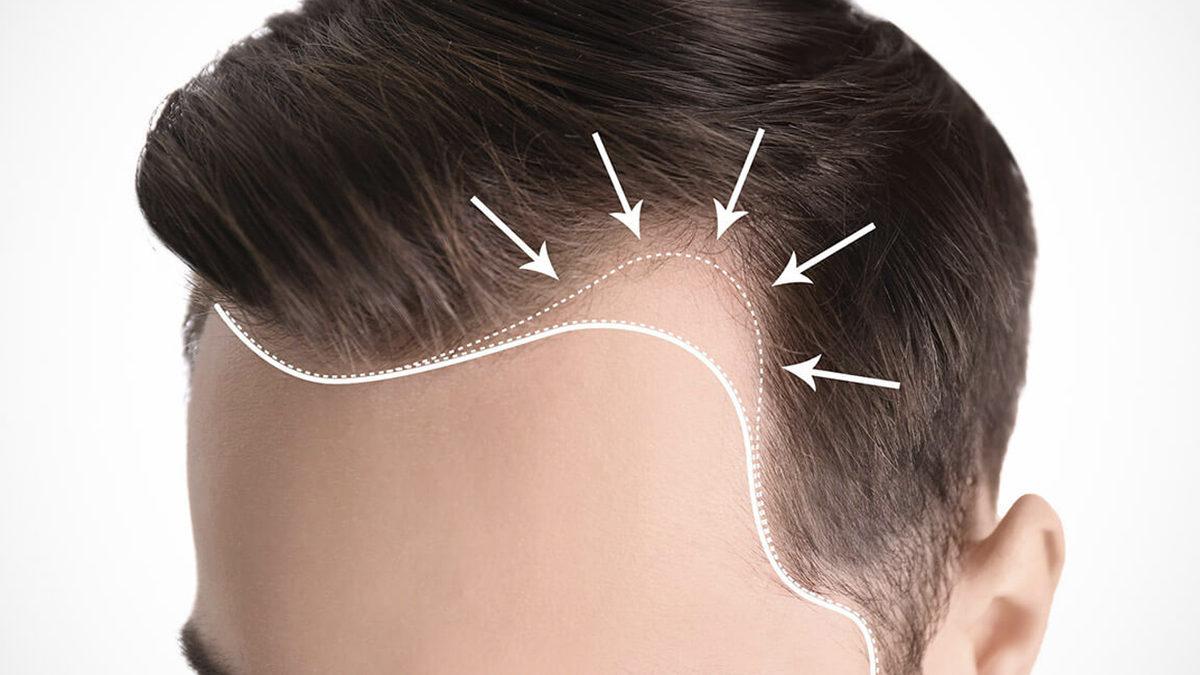 Erkeklerin Saç Çizgisi Neden Bariz Şekilde Kadınlardan Daha Farklı? Kabul Edelim, Kadınlar Daha Şanslı!