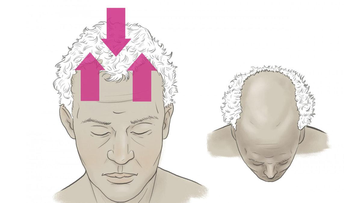 Erkeklerin Saç Çizgisi Neden Bariz Şekilde Kadınlardan Daha Farklı? Kabul Edelim, Kadınlar Daha Şanslı!