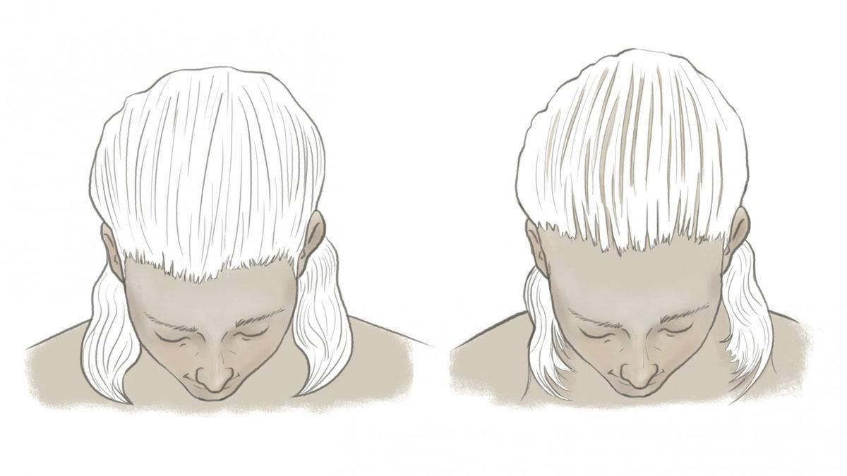 Erkeklerin Saç Çizgisi Neden Bariz Şekilde Kadınlardan Daha Farklı? Kabul Edelim, Kadınlar Daha Şanslı!