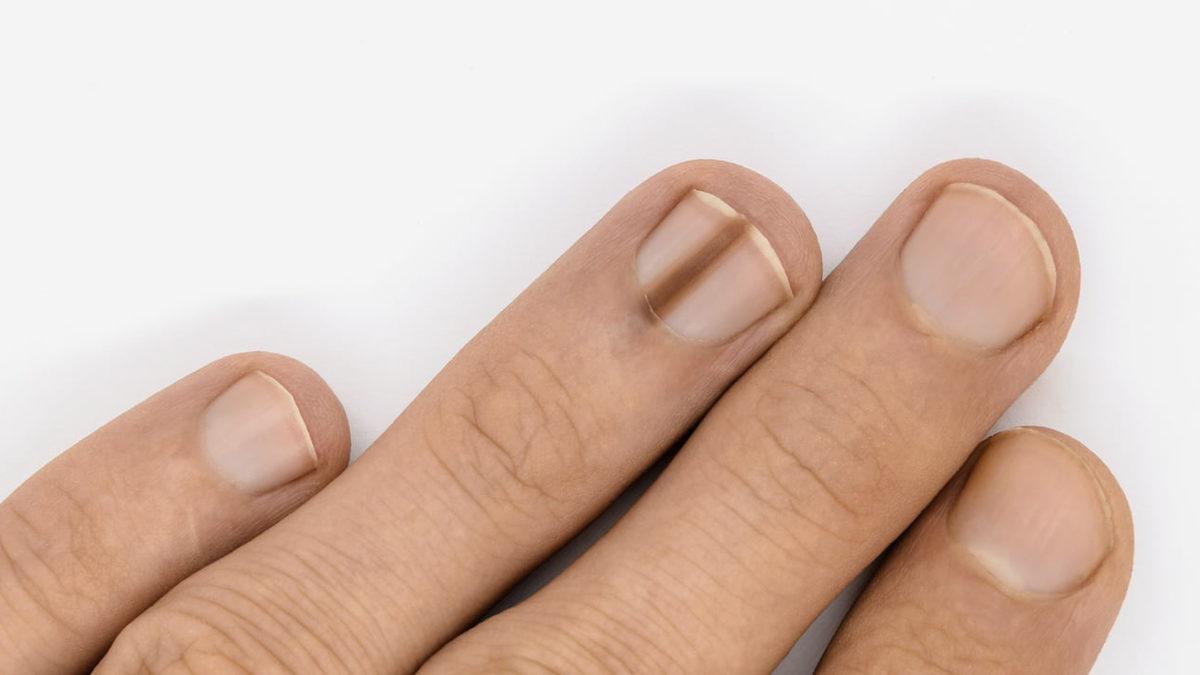 Tırnaklarınızda Beliren Bu Siyah Çizgiler Ne Anlama Geliyor?