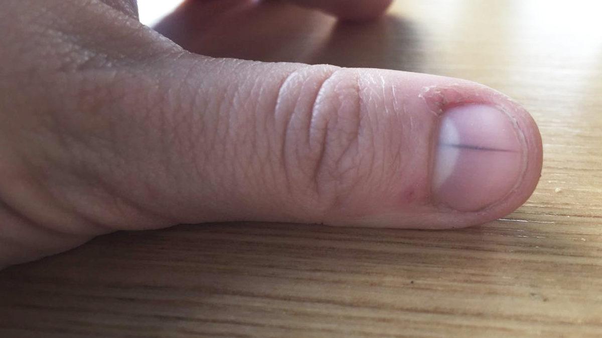 Tırnaklarınızda Beliren Bu Siyah Çizgiler Ne Anlama Geliyor?