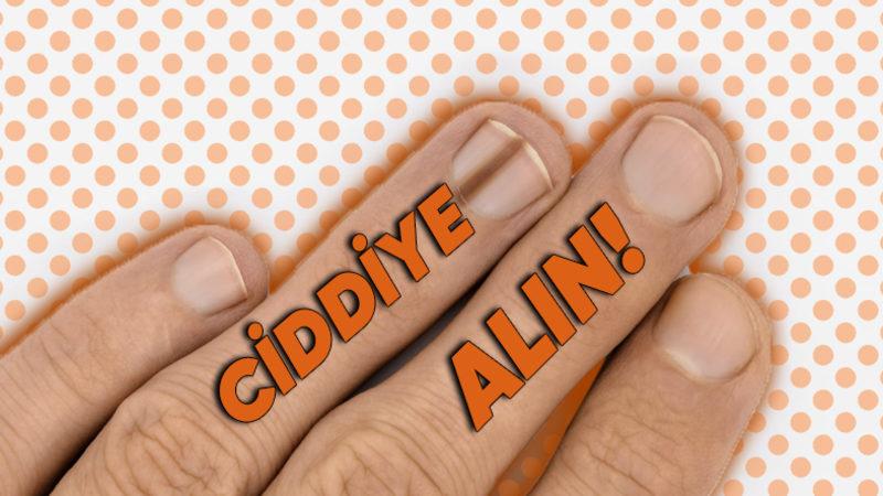 Tırnaklarınızda Beliren Bu Siyah Çizgiler Ne Anlama Geliyor?