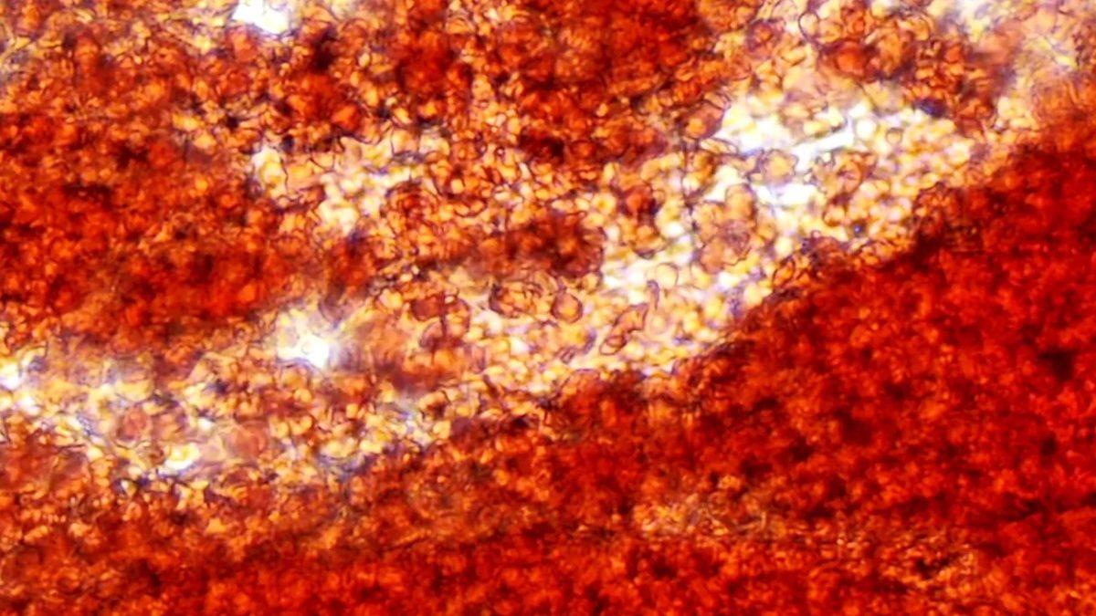 Kalp, Beyin ve Bacaklardaki Kan Pıhtılarda Mikroplastik Bulundu