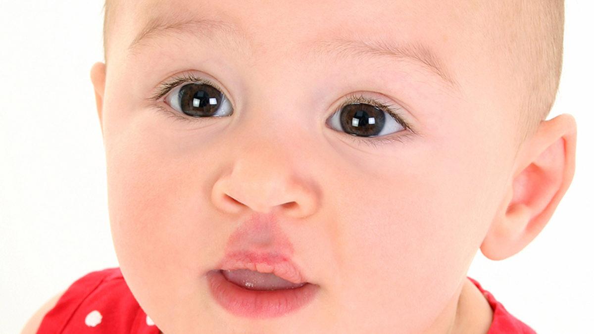 Çilek ve Şarap Lekesi Gibi Doğum Lekeleri Neden Oluşuyor? Aslında Önlenebilir mi?