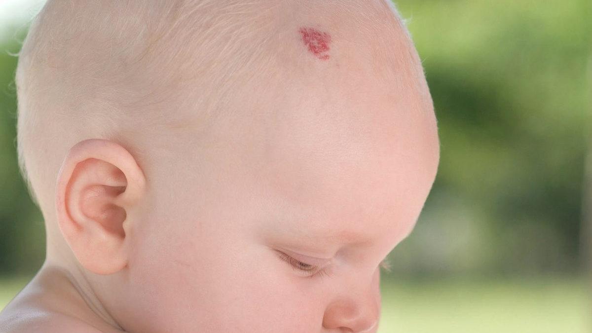 Çilek ve Şarap Lekesi Gibi Doğum Lekeleri Neden Oluşuyor? Aslında Önlenebilir mi?