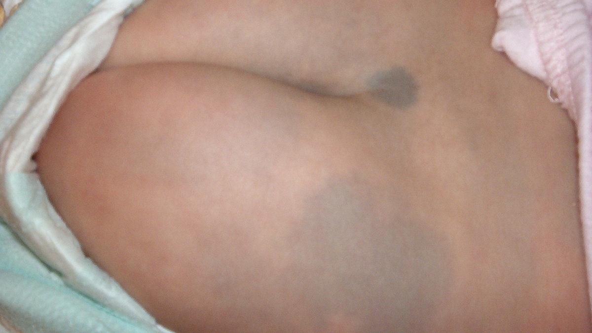 Çilek ve Şarap Lekesi Gibi Doğum Lekeleri Neden Oluşuyor? Aslında Önlenebilir mi?