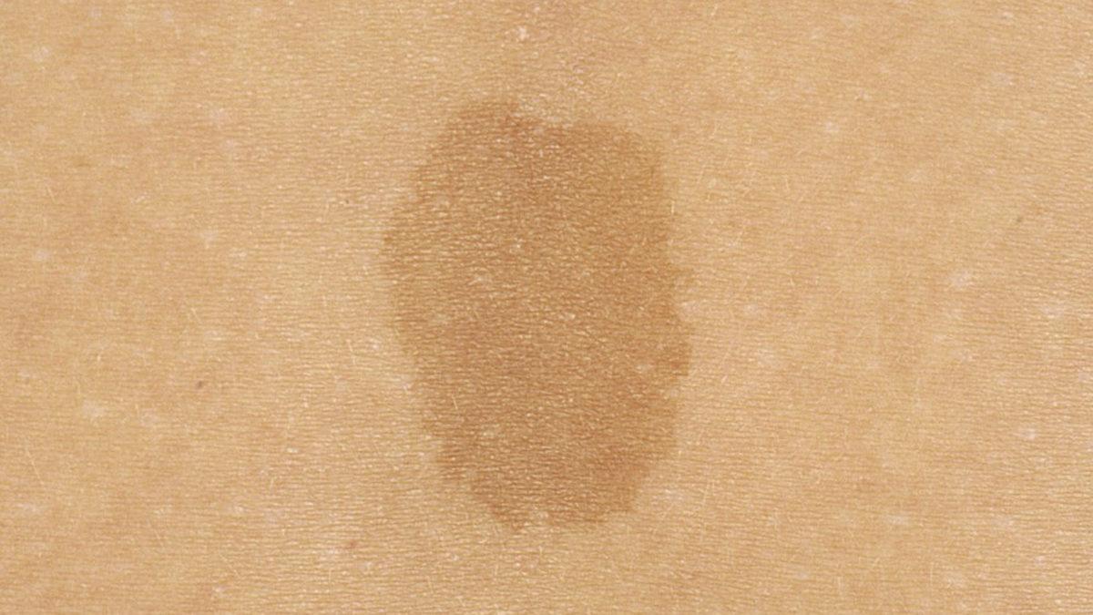 Çilek ve Şarap Lekesi Gibi Doğum Lekeleri Neden Oluşuyor? Aslında Önlenebilir mi?