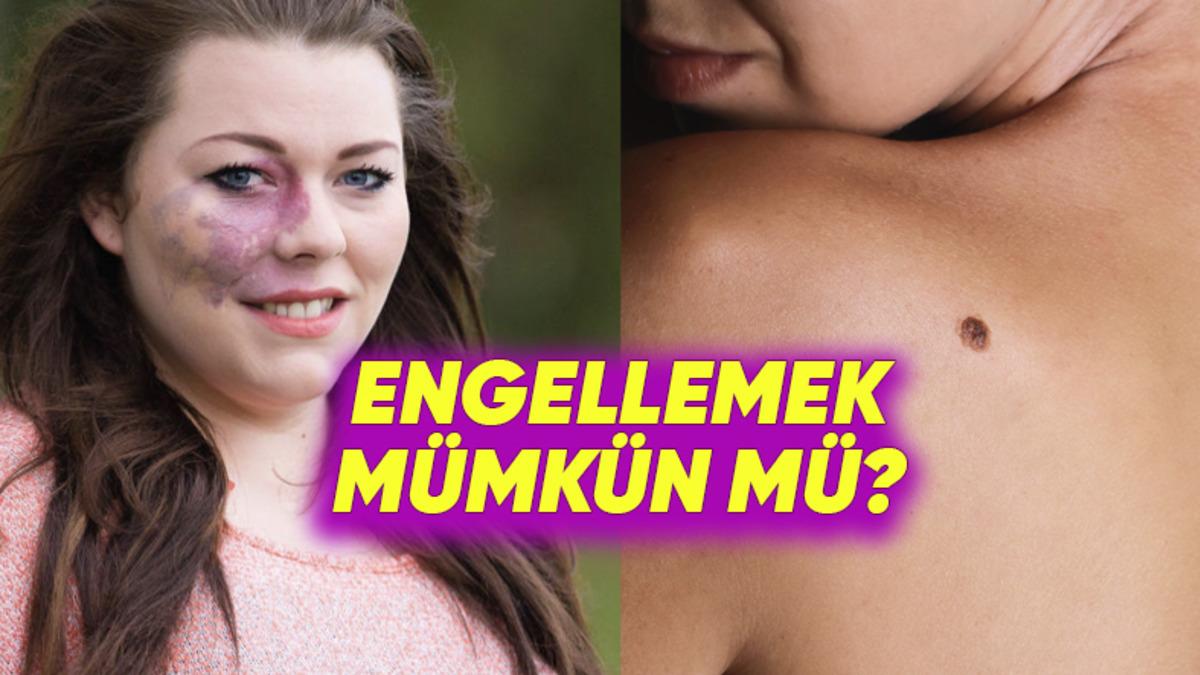 Çilek ve Şarap Lekesi Gibi Doğum Lekeleri Neden Oluşuyor? Aslında Önlenebilir mi?