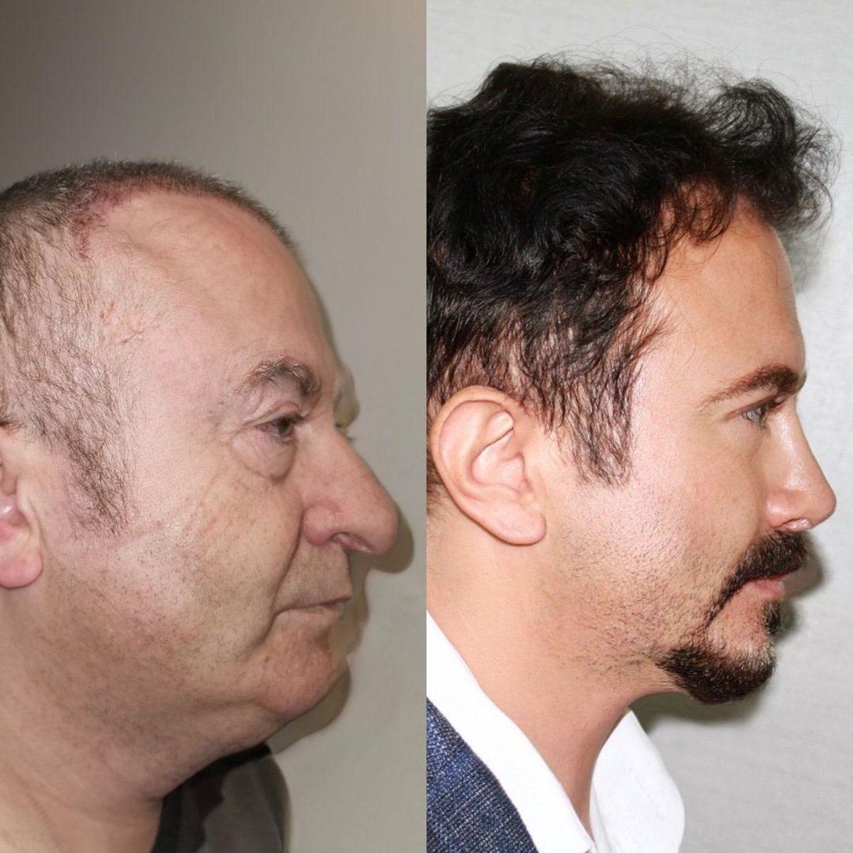 Türkiye’ye Gelip, 7 Estetik Operasyon Sonrası Âdeta 30 Yıl Gençleşen Adam Dünya Çapında Gündem Oldu