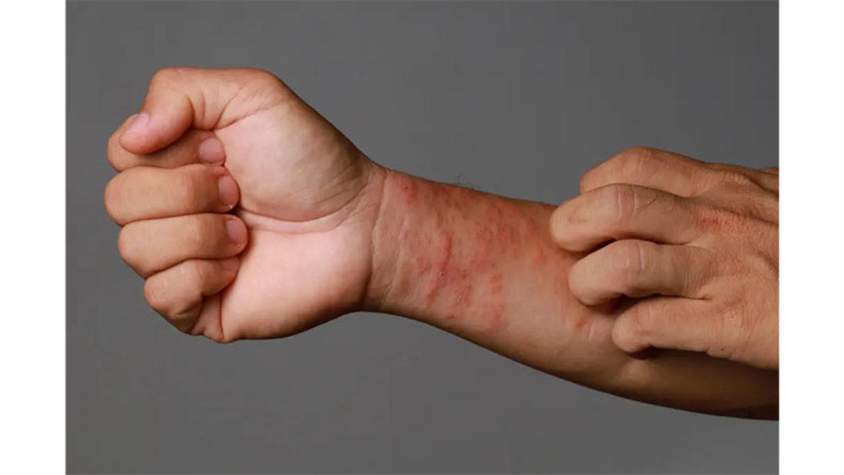 Dikkat! Bunu Okurken de Kaşınabilirsiniz: Kaşınan Birini Görünce Neden Biz de Kaşıntımızı Durduramayız?